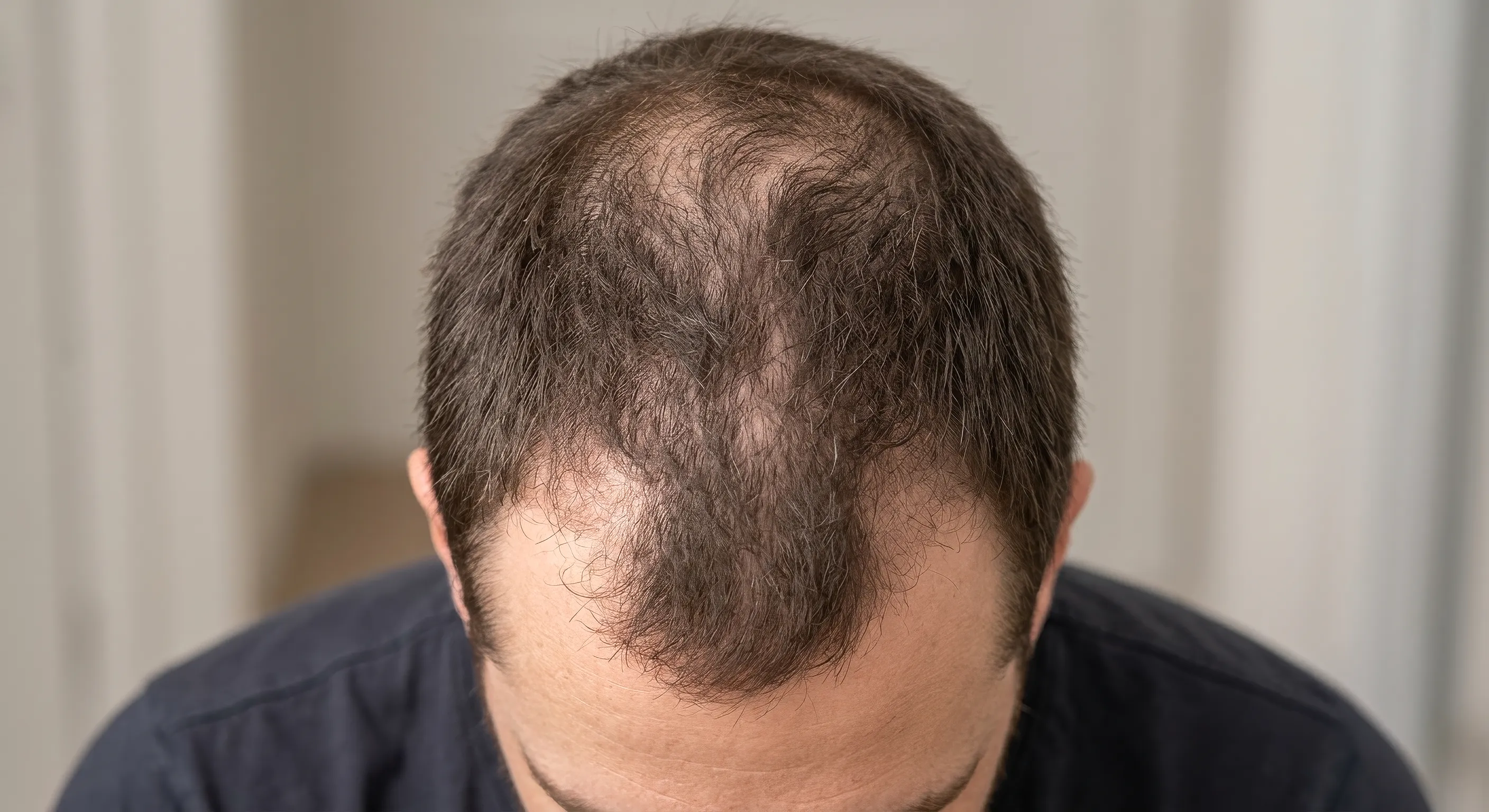 Alopecia (hombre)