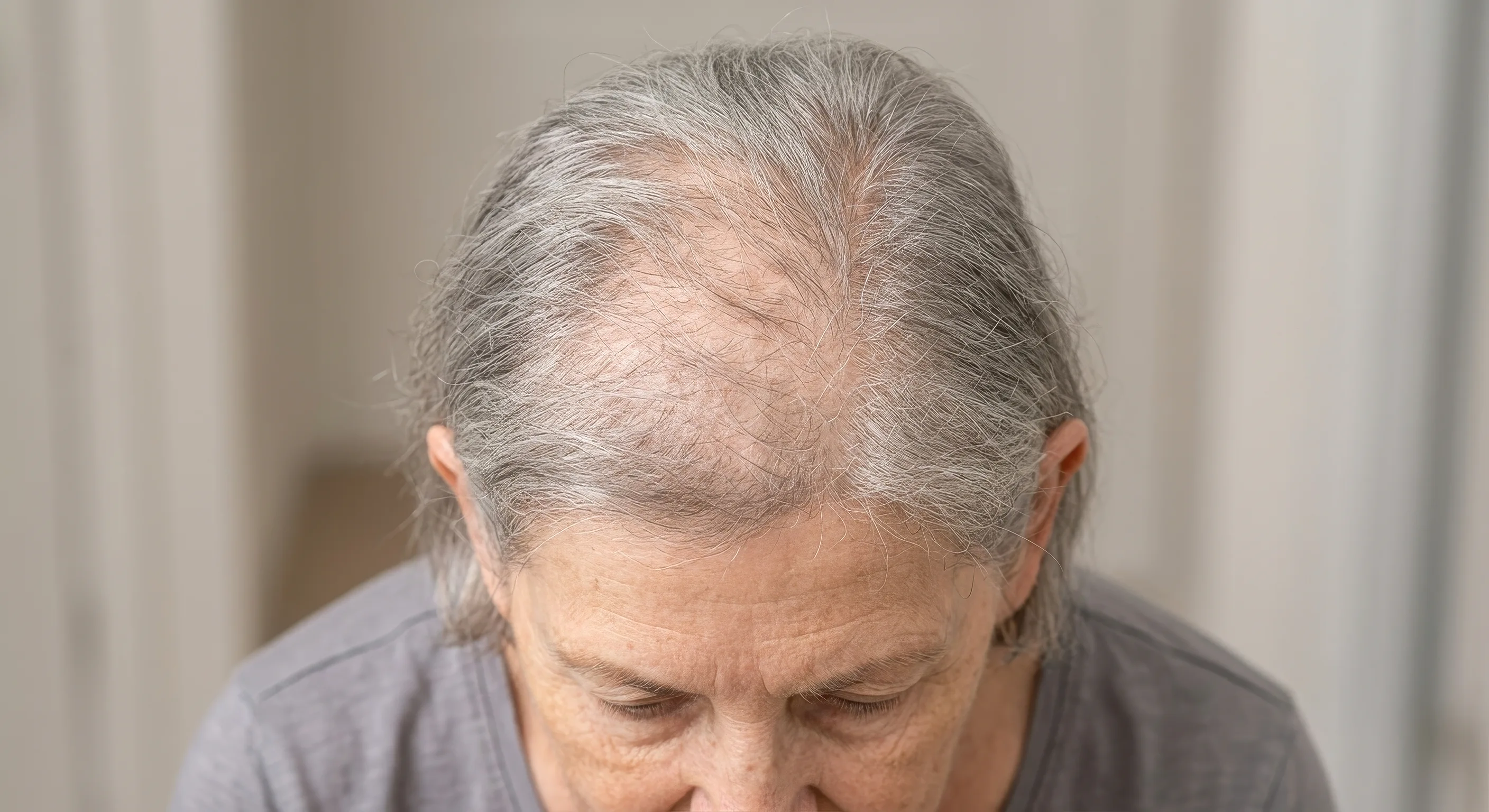 Alopecia (mujer)